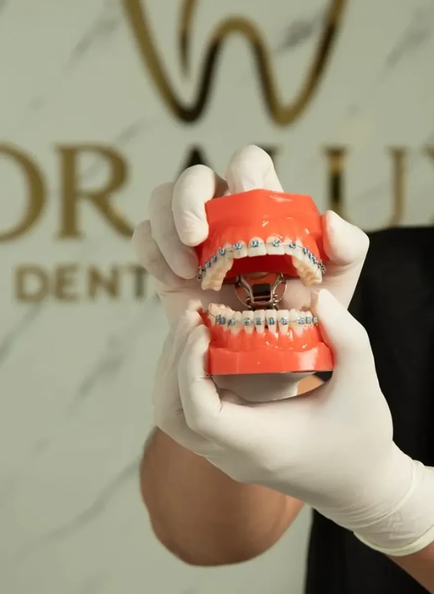 Detalle ampliado de un tipodont con brackets sostenido con guantes de odontología