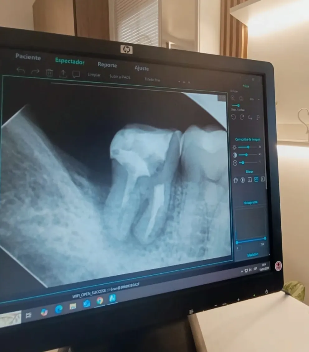 Radiografía dental digital visualizada en una pantalla de ORALUX como recurso de diagnóstico